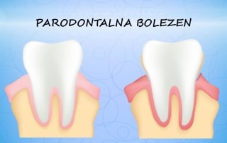 Paradontoza ali parodontoza