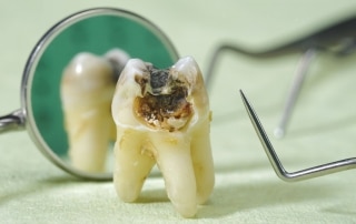 Karies uniči zob