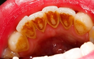 Zobni kamen se nabira na zobeh