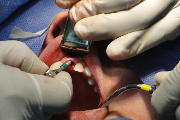 Vstavljanje zobnih vsadkov oziroma implantatov