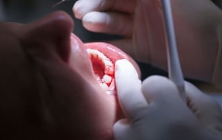 Vnetje dlesni povzroča krvavenje