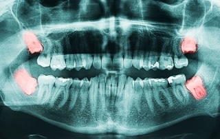 RTG posnetek modrostnih zob