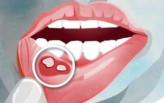 Afte, herpes in druge težave na spodnji ustnici