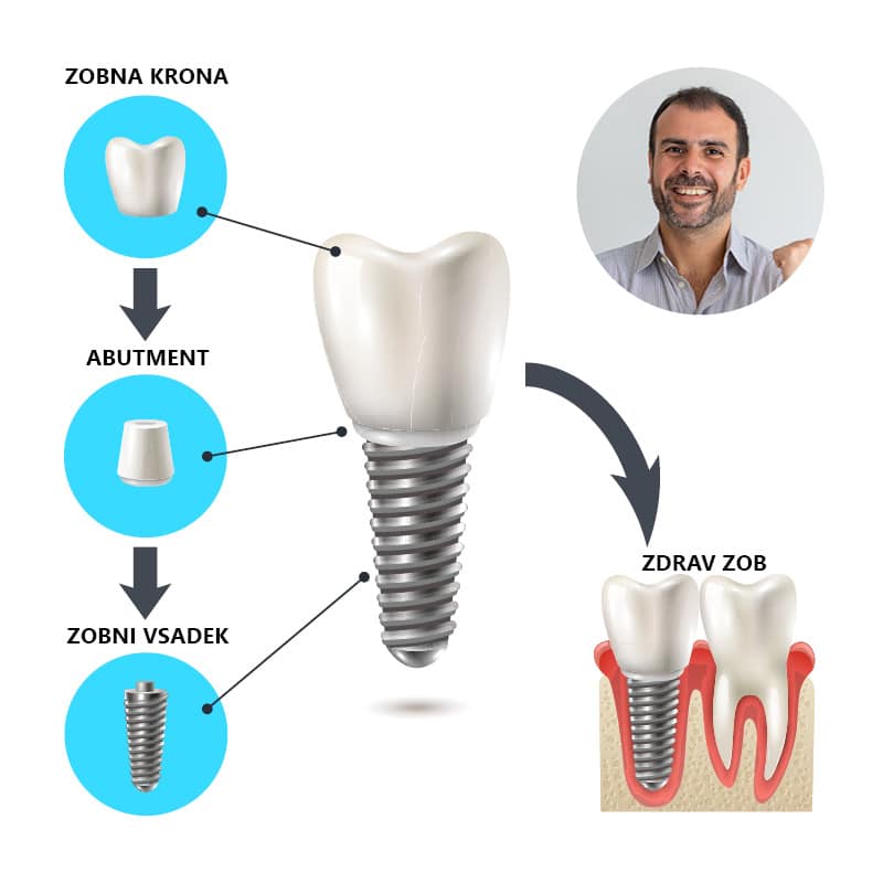 kam-po-vsadek-09 Implantat - sestava