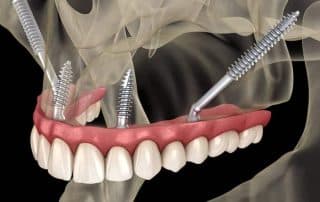 Zygoma implantat za zobe se vstavi v ličnico