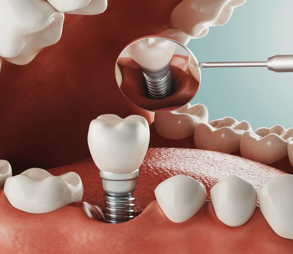 Zobozdravniki beležijo veliko uspešnost pri vstavitvi zobnih vsadkov.