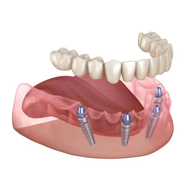 Zobne proteze so lahko pričvrščene tudi na implantate.