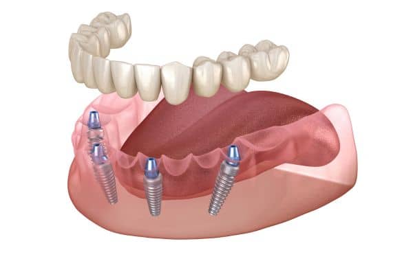 Zobna protetika - Zobne luske