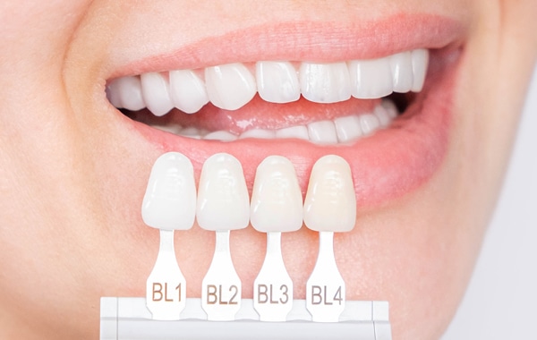 Zobna protetika - Zobne luske